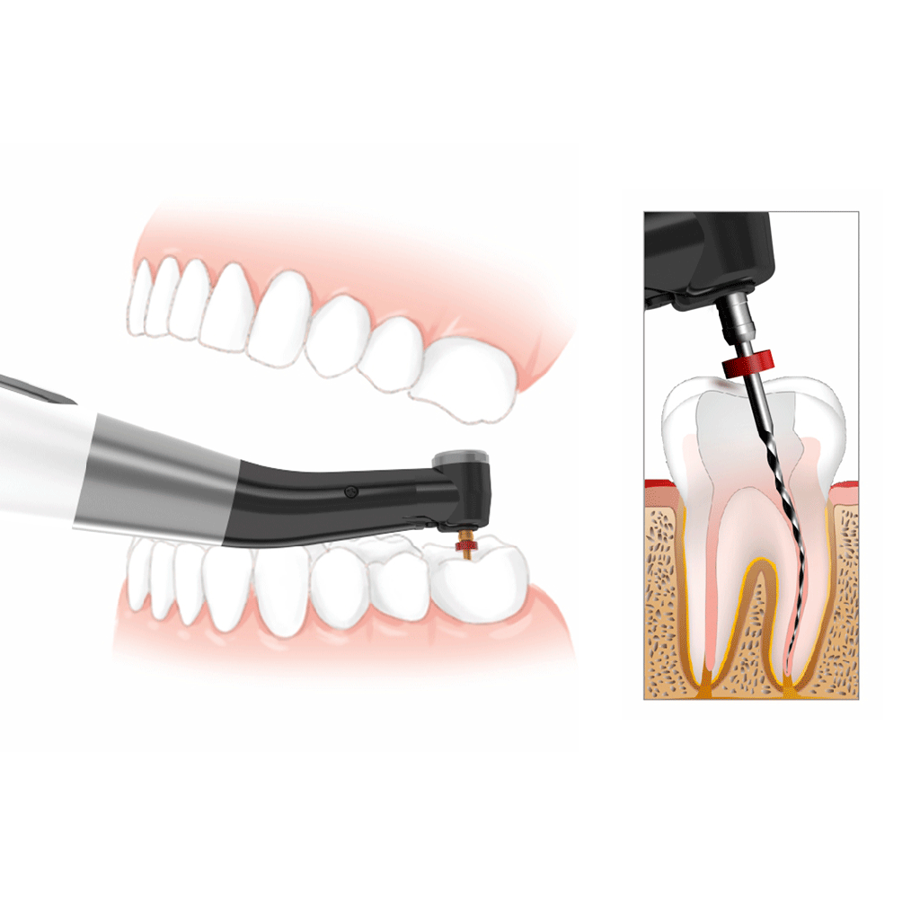 Micromotor para Endodoncia Mecanizada + Localizador, ENDOMATIC. DTE WOODPECKER