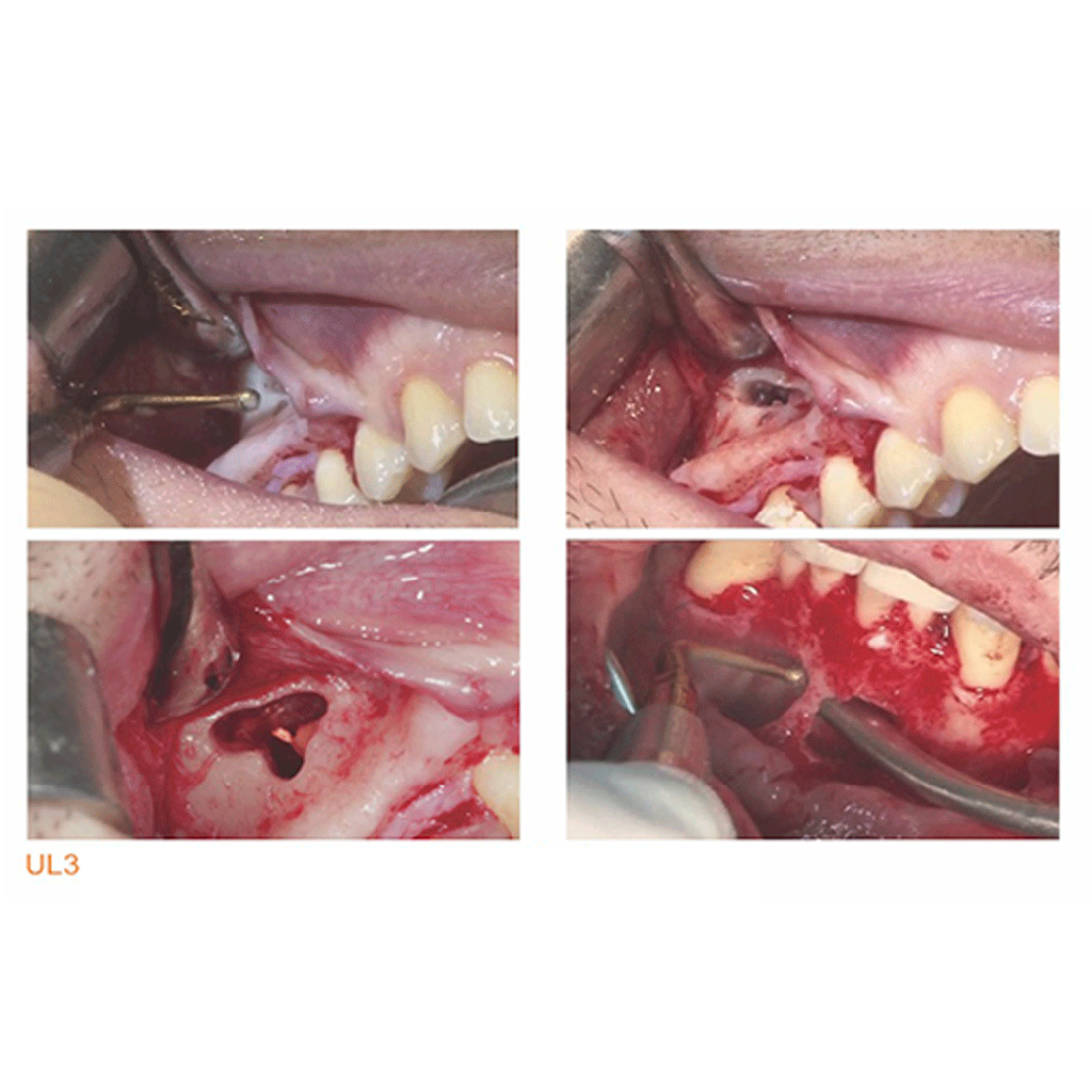 Punta Sinus Lifting para Piezo Surgery (UL3). WOODPECKER