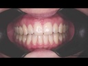 Kit de Espejos x 4u, con desempañador Eléctrico y luz LED. FOTODENTAL